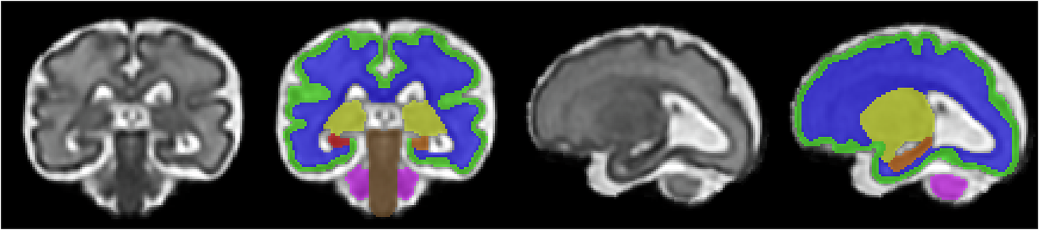 Fig. 1: Fetal brain segmentation.