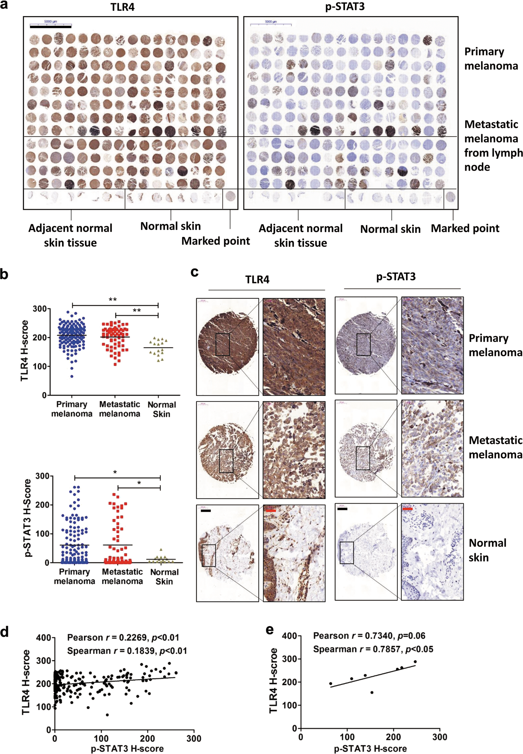 Fig. 1: TLR4 expression and STAT3 phosphorylation positively correlate in human melanoma samples.