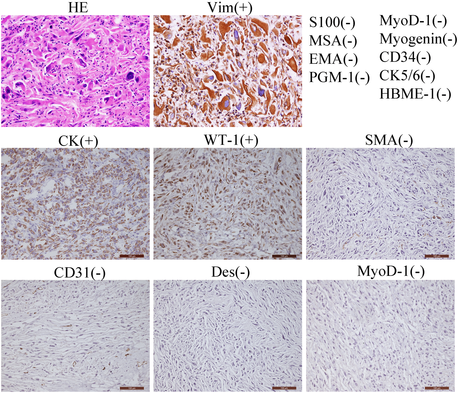 Fig. 2: Pathological diagnosis of primary cardiac malignant fibrous histiocytoma (MFH).