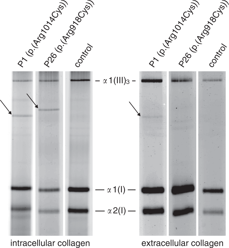 Fig. 2: Sodium dodecyl sulfate polyacrylamide gel electrophoresis (SDS-PAGE) on (pro)collagen extracted from patient skin fibroblasts.