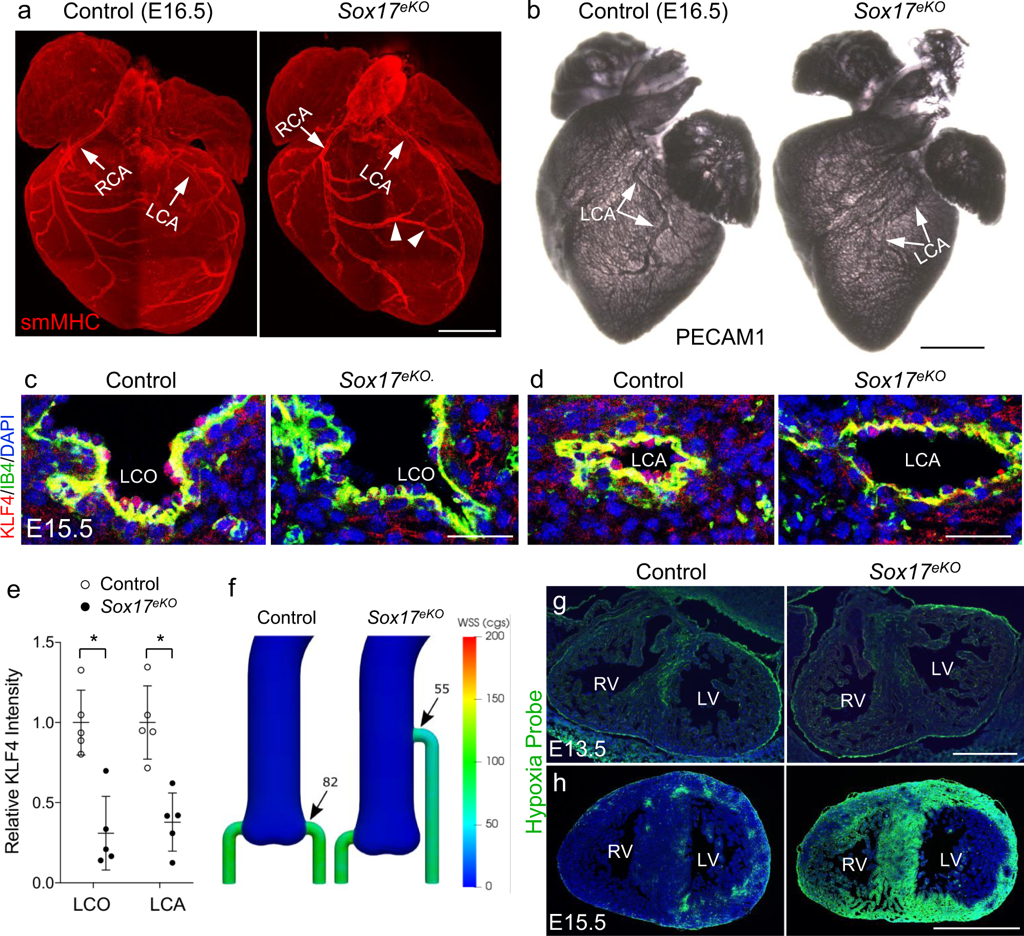 Fig. 5: Misplaced LCO causes reduced coronary flow, leading to lethal anomalous coronary arteries.