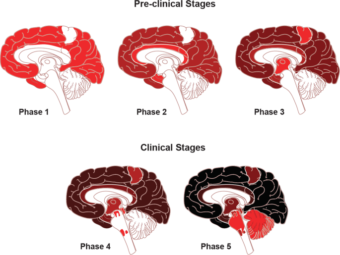 Fig. 1: Traditional neuropathological phases of amyloid-β deposition in Alzheimer’s disease dementia.
