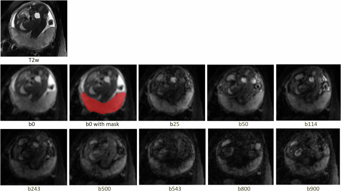 Fig. 2: Placenta imaging.