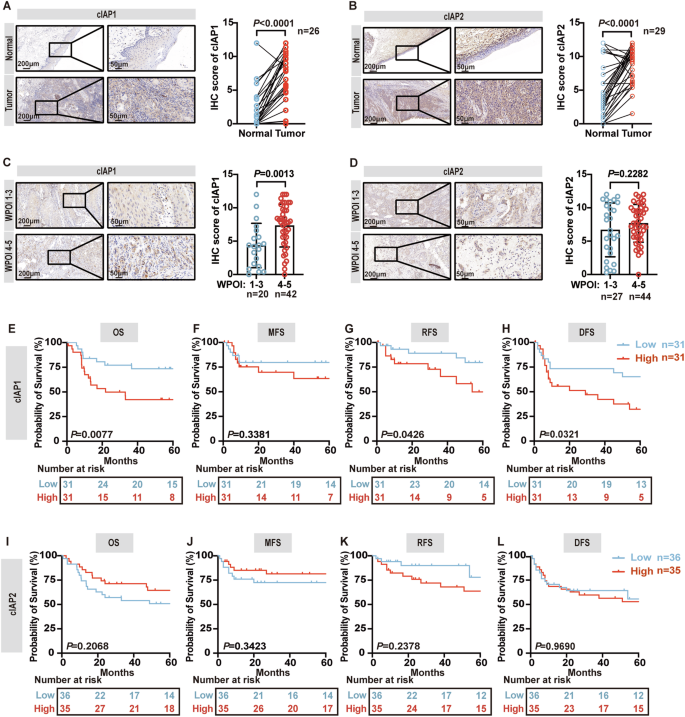 Fig. 2: cIAP1 is aberrantly expressed in OSCC and predicts poor clinical outcomes.