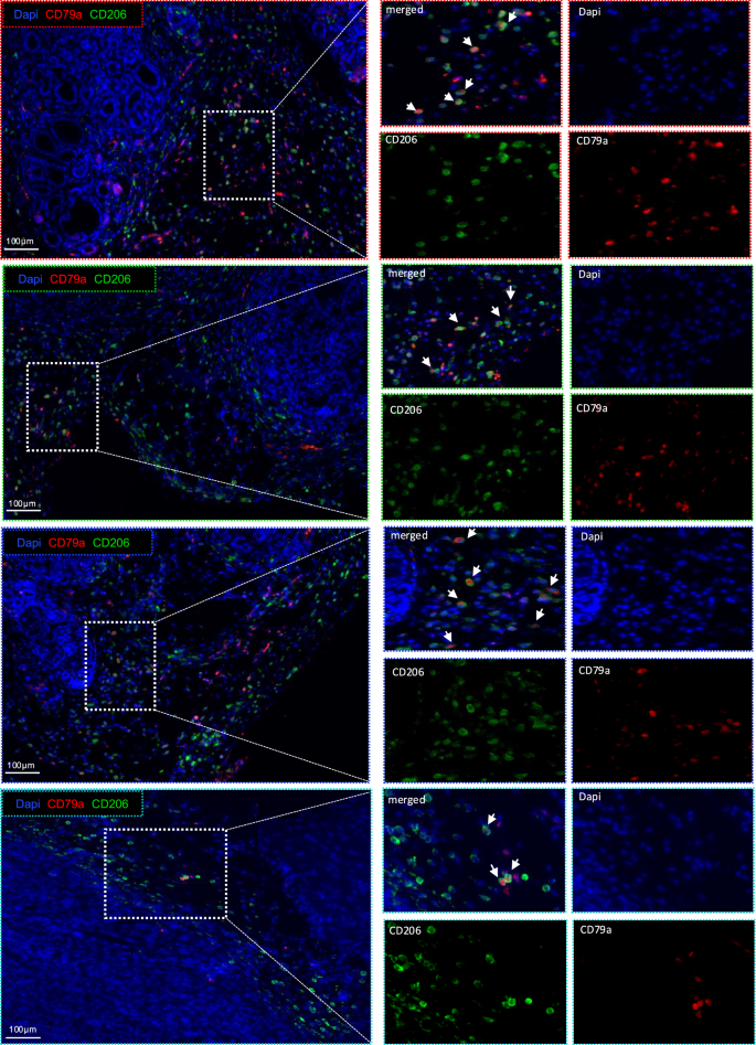 Fig. 3: Tumor-associated macrophages express the B cell-specific marker CD79a.