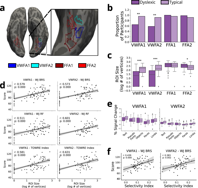 Fig. 2: Visual Word Form Area Size and Selectivity Is Related to Reading Ability at Baseline.