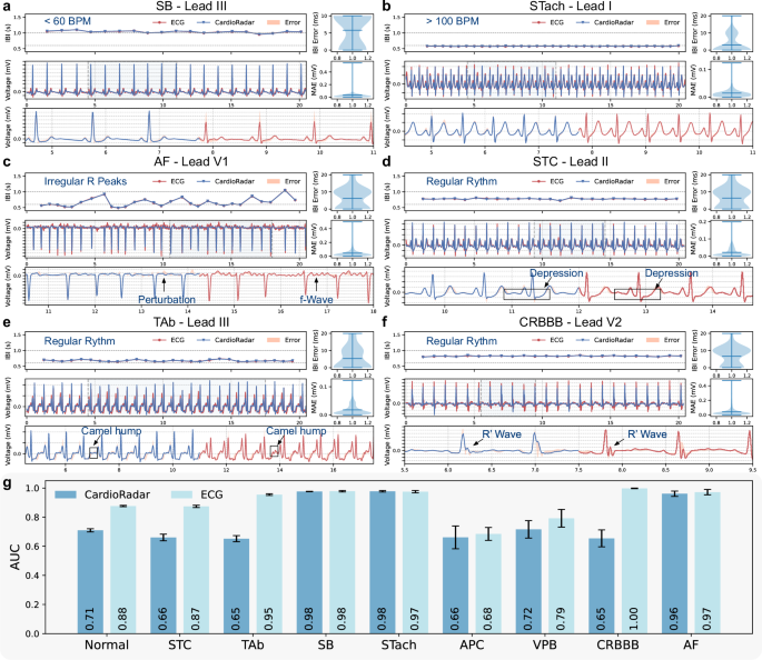 Fig. 4: Examples of reconstructed ECG signals for various abnormalities.