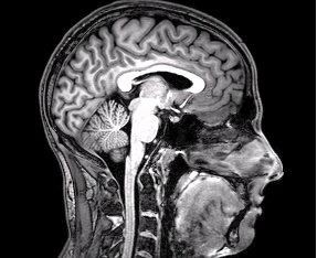 © DrOONeil, File:FMRI Brain Scan.jpg. Wikimedia. https://commons.wikimedia.org/wiki/File:FMRI_Brain_Scan.jpg#  (CC BY-SA 3.0)