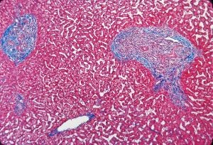 Liver fibrosis. Light micrograph of a liver biopsy stained with trichrome stain. The areas of fibrosis (collagen) are stained blue. The hepatocyte (liver cell) cytoplasm is stained red.