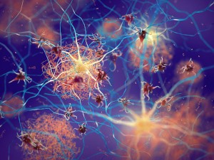 Amyloid plaques forming between neurons