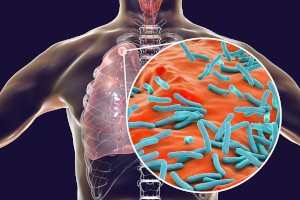 Secondary tuberculosis in lungs and close-up view of Mycobacterium tuberculosis bacteria