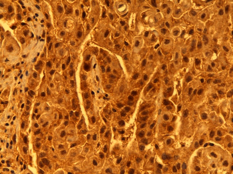 Mesothelioma Microvilli