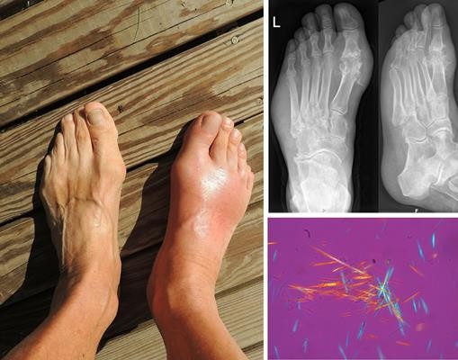 Diagnosis of gout image