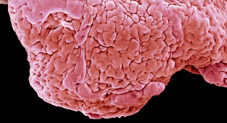A coloured scanning electron micrograph of a section of human intestine with ulcerative colitis.