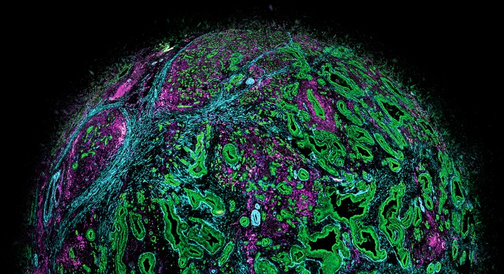 Spatial resolution of pancreatic cancer