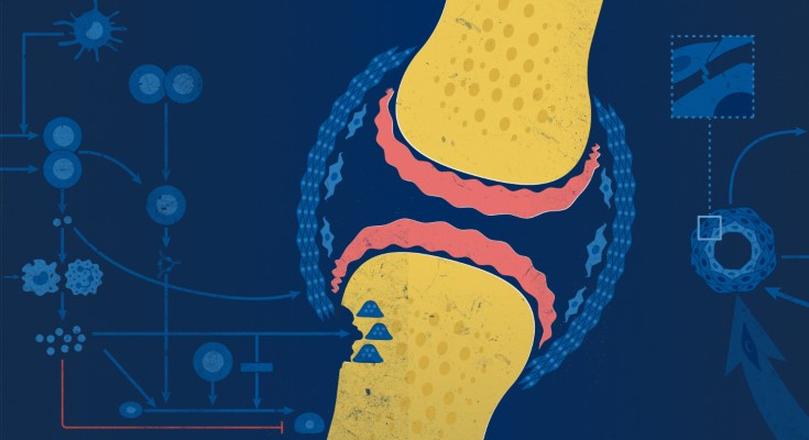 Synovial joint with rheumatoid arthritis