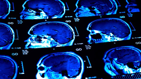 The brain complications of COVID-19