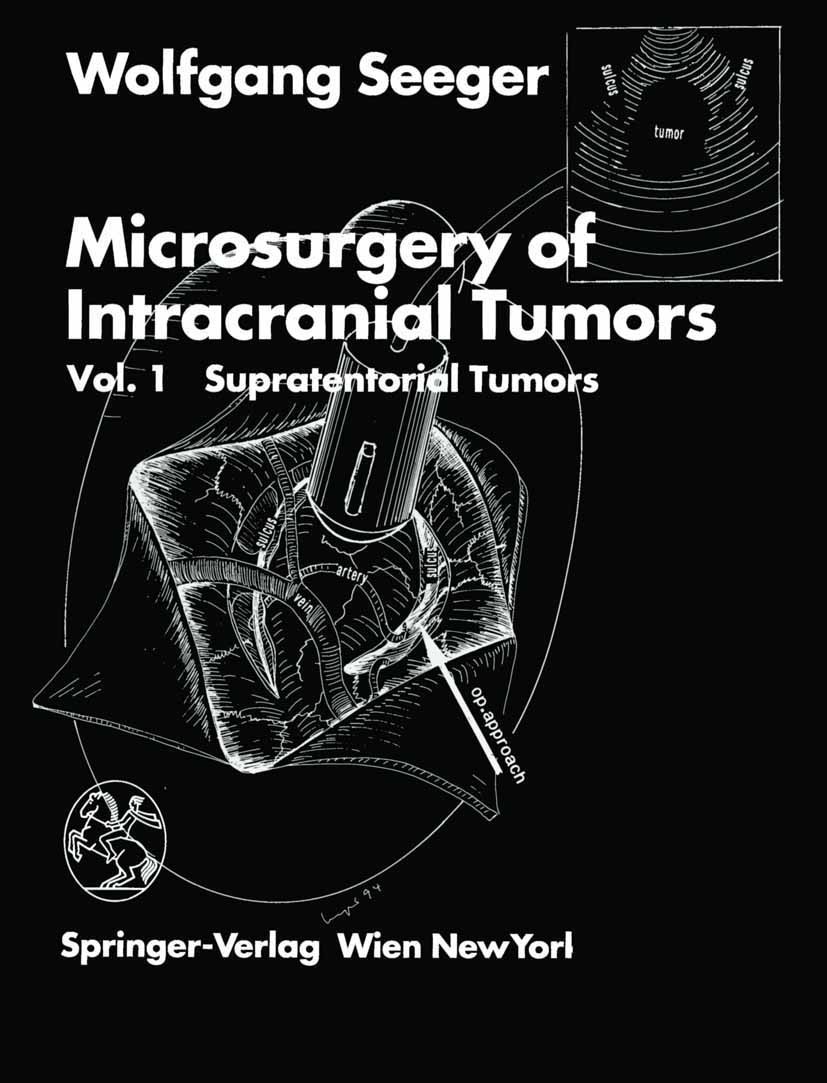 Microsurgery of Intracranial Tumors: Vol 1: Supratentorial Tumors | SpringerLink Microsurgery of Intracranial Tumors: Vol 1: Supratentorial Tumors | SpringerLink