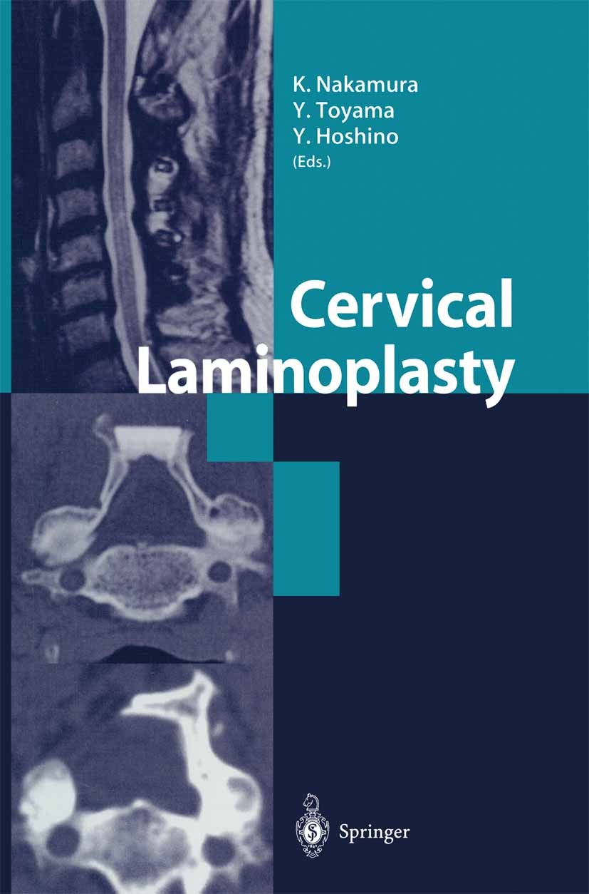 Cervical Laminoplasty | Springer Nature Link (formerly SpringerLink)