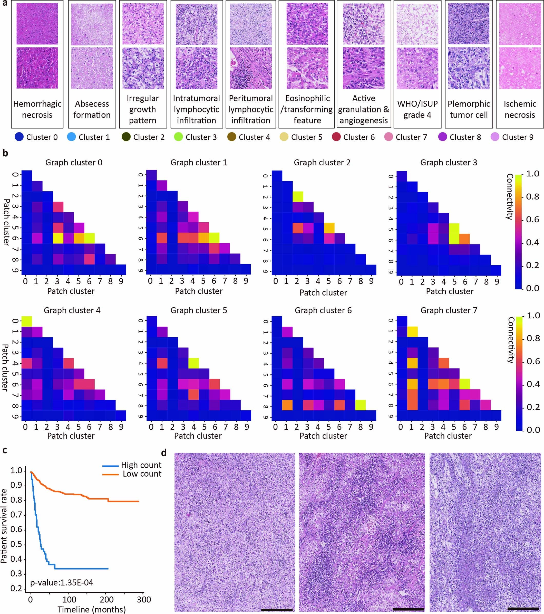 Extended Data Fig. 6: Contextual pathological characteristics of high IG group.
