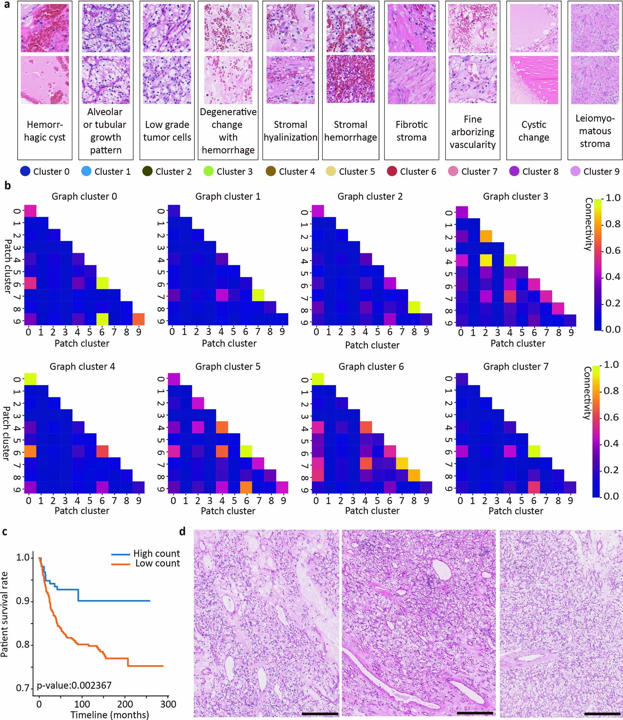 Extended Data Fig. 7: Contextual pathological characteristics of low IG group.
