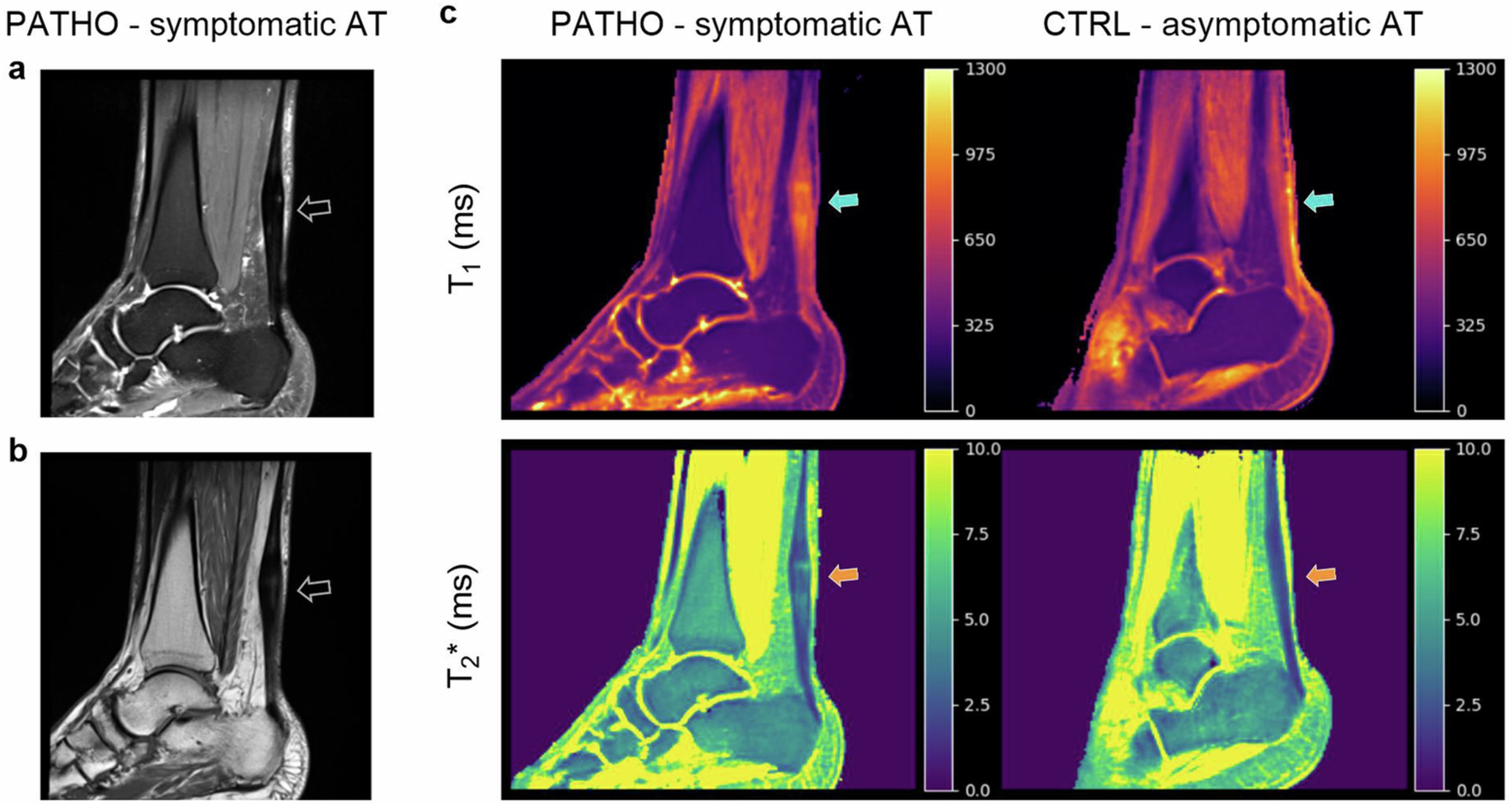 Extended Data Fig. 2: MRI scans performed in vivo on a patient shows the gained insight into tissue properties by the UTE sequences compared with standard clinical imaging sequences for tendon.
