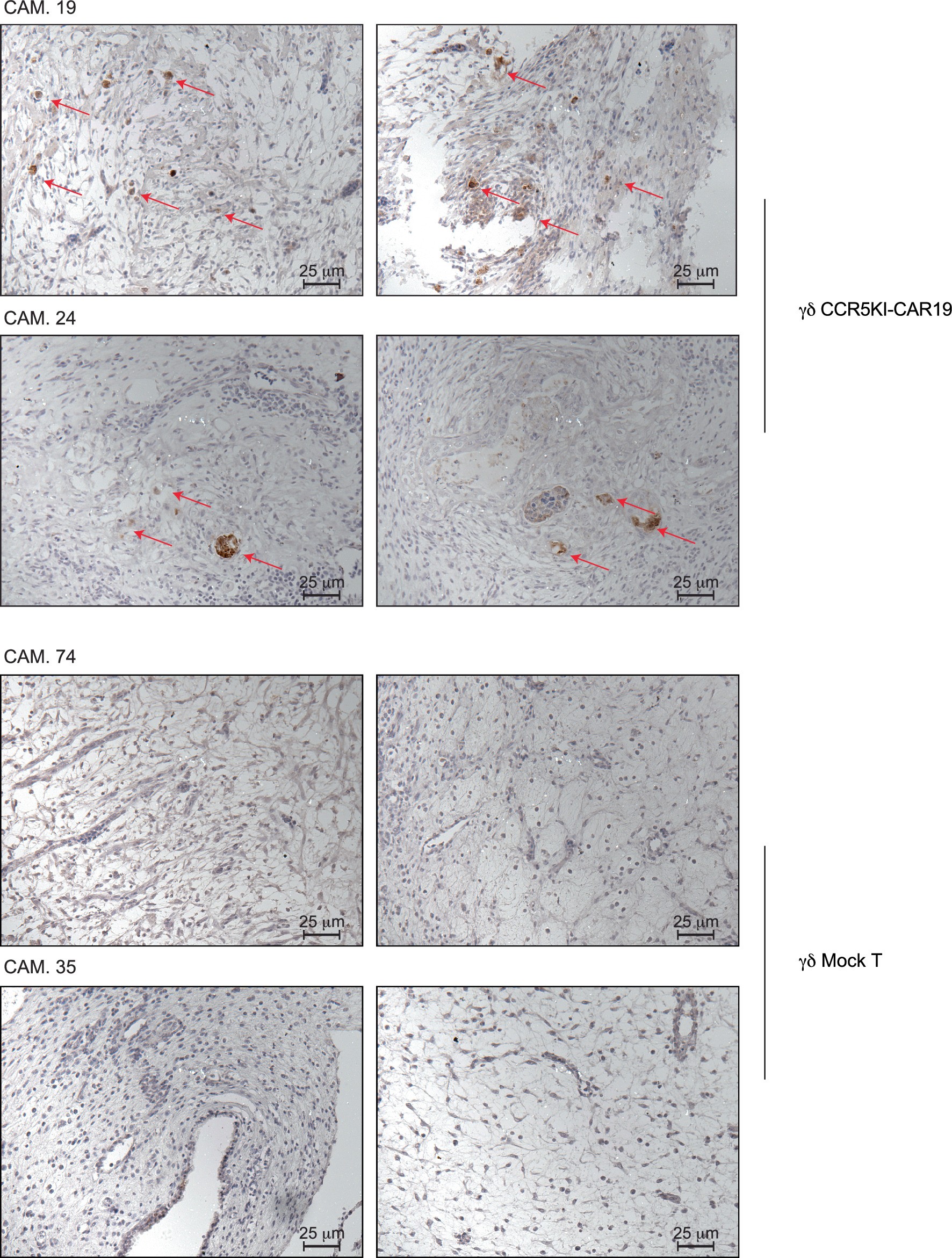 Extended Data Fig. 4: Caspase‑3 immunohistochemical staining in tumor tissues from γδ CCR5KI CAR19 and γδ mock T cell treated mice.