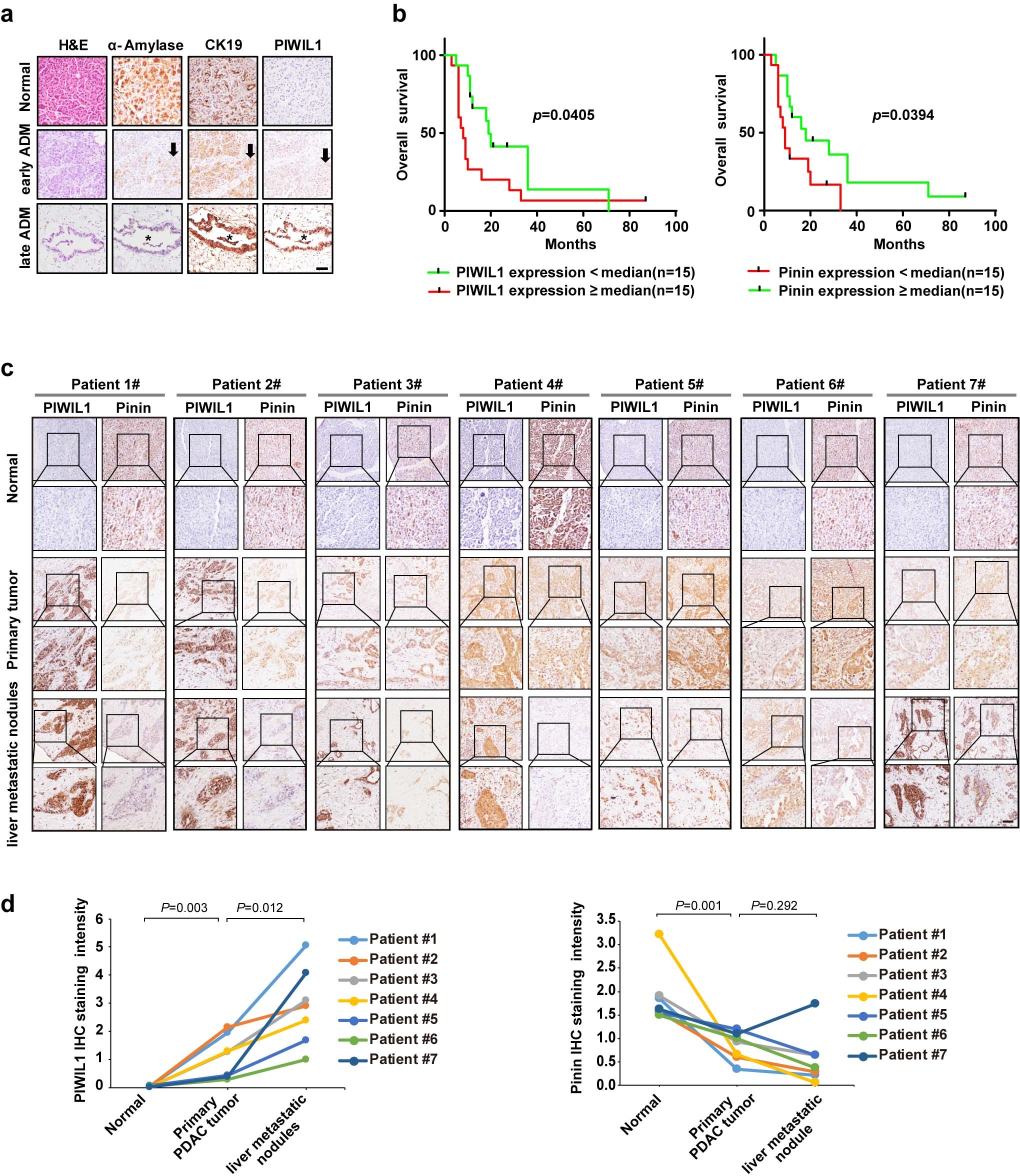 Extended Data Fig. 10: Clinical relevance of the APCPIWIL1-Pinin axis in PDAC patients.