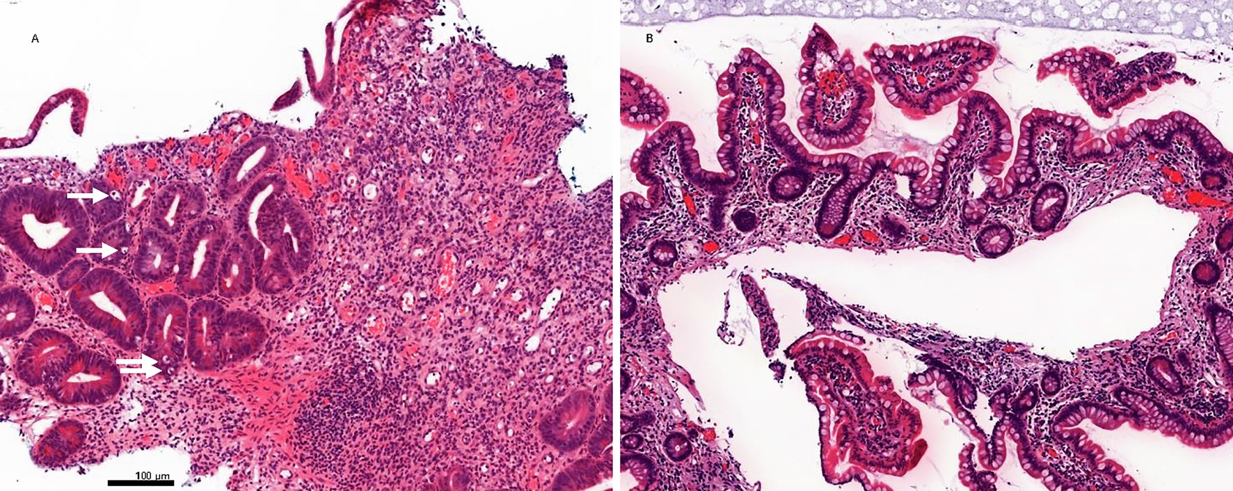 Extended Data Fig. 1: Histological image of small intestinal mucosa post HSCT.