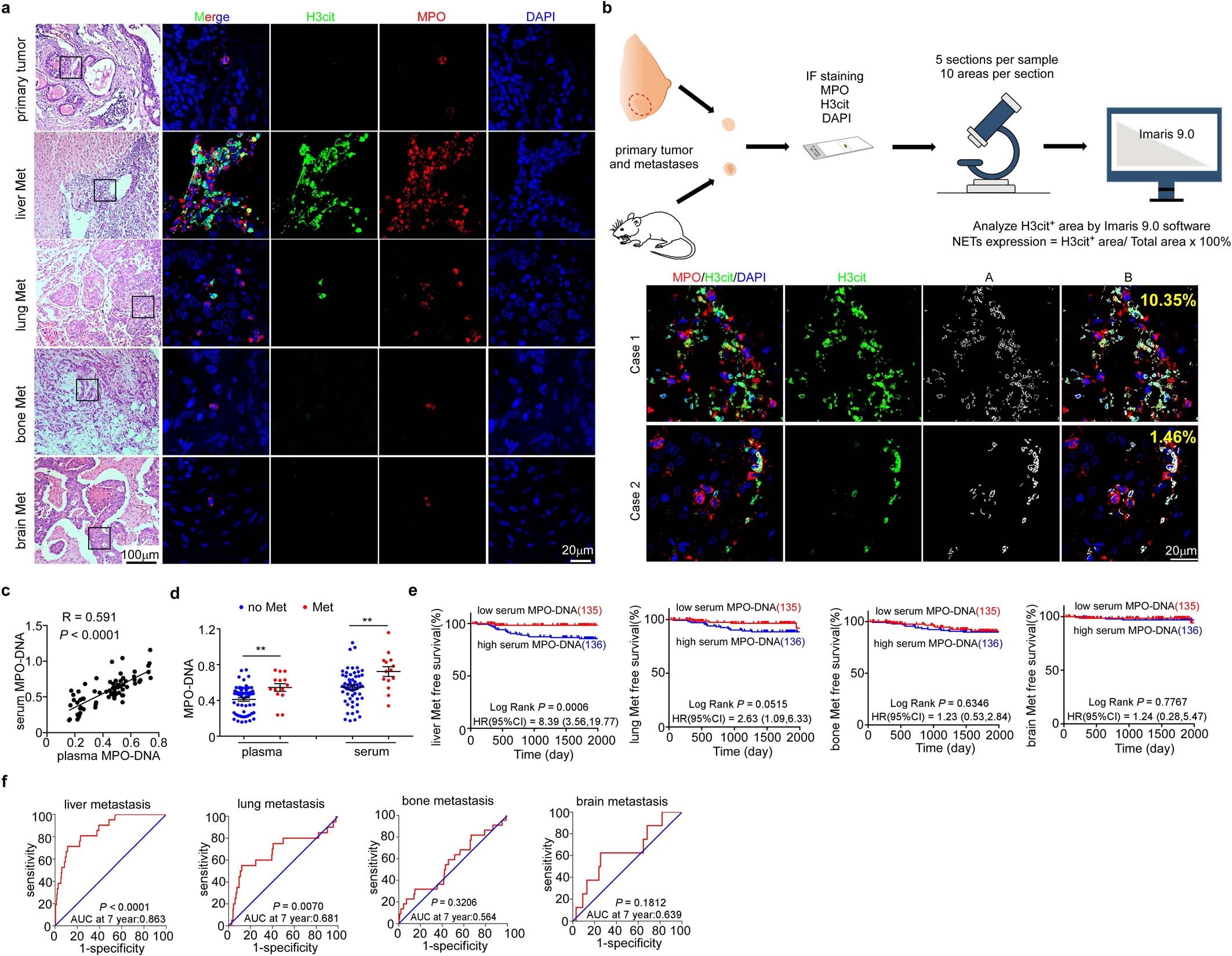 Extended Data Fig. 1: NETs are predominantly presented in liver metastases of breast cancer.