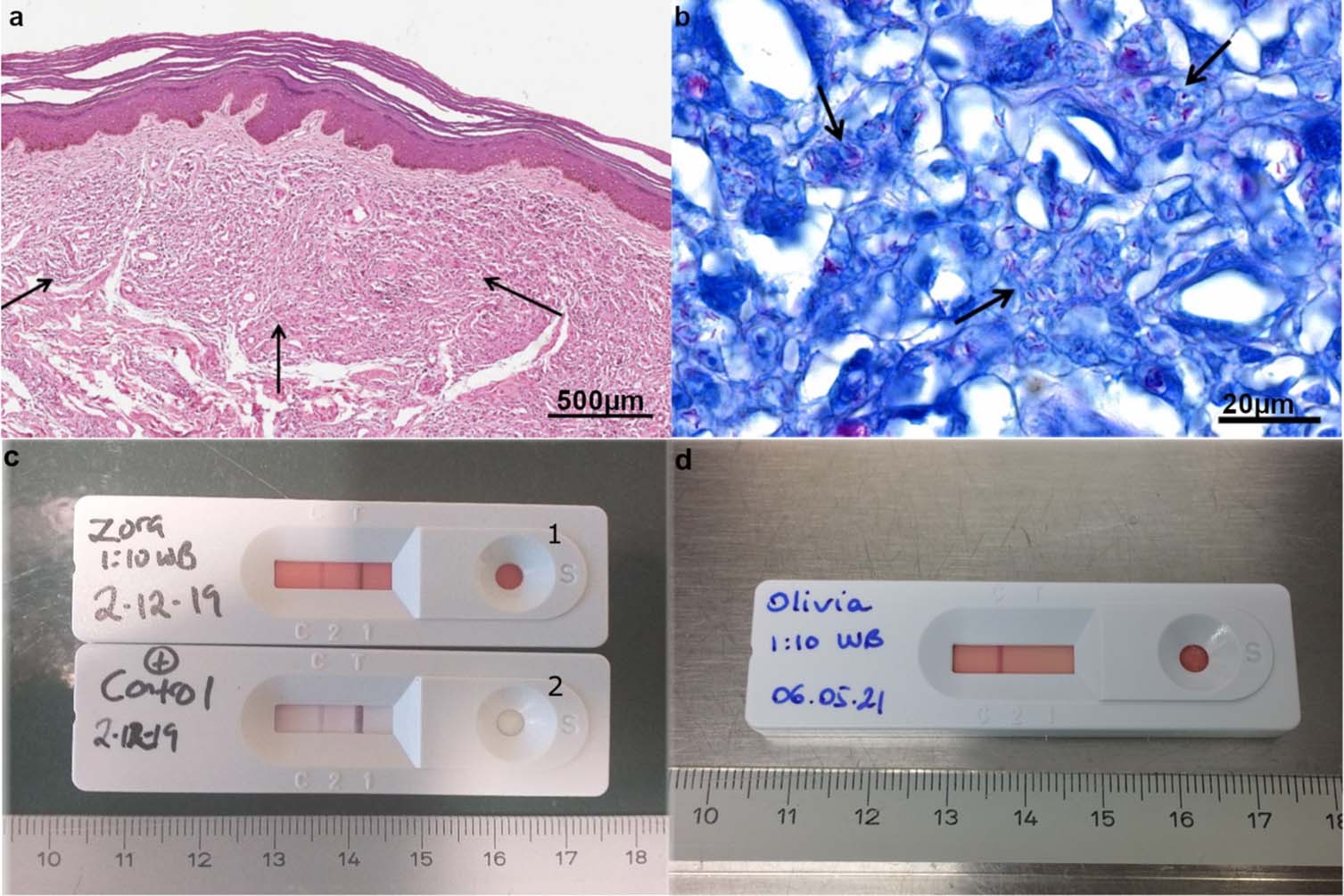 Extended Data Fig. 4: Confirmation of leprosy infection in Zora through histopathology of skin sample and lateral flow test.