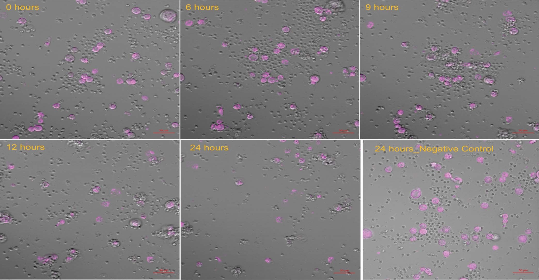 Extended Data Fig. 5: Time lapse of Her2 Tri-specific antibody induced T-cell mediated killing of target HER2+ MDA-MB-453 breast cancer cells.
