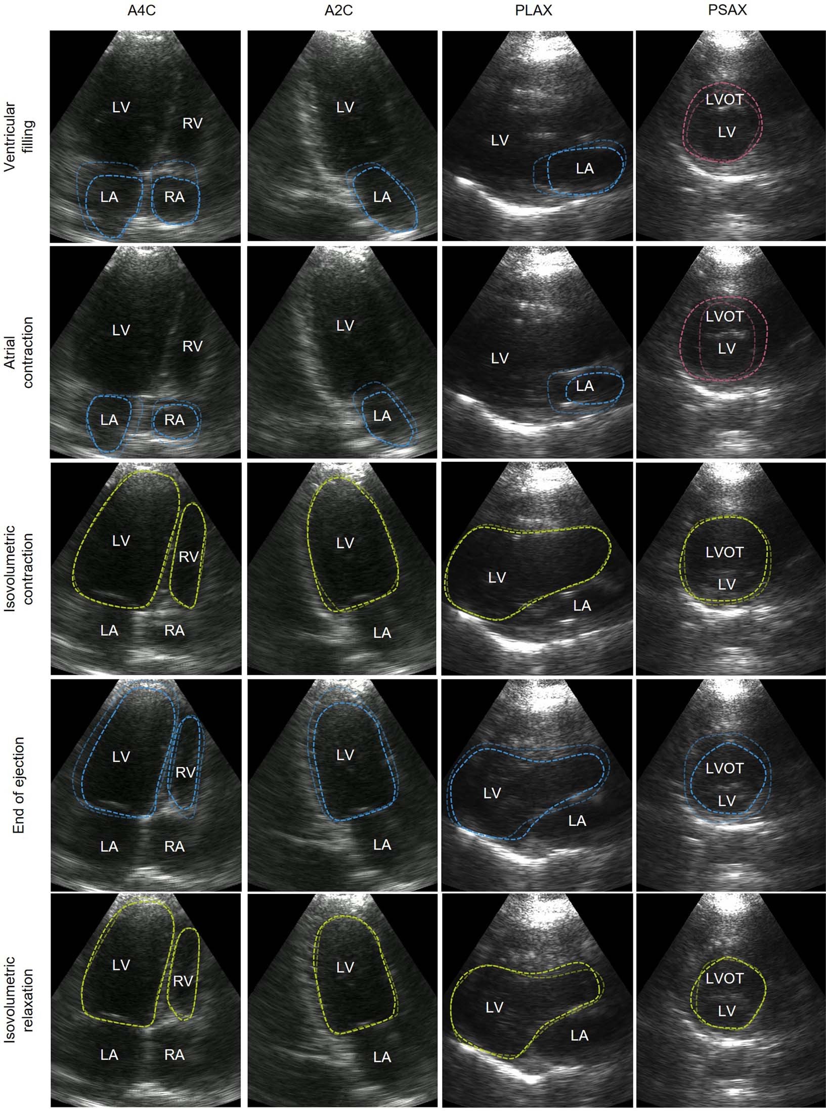 Extended Data Fig. 8: Different phases in a cardiac cycle obtained from B-mode imaging.
