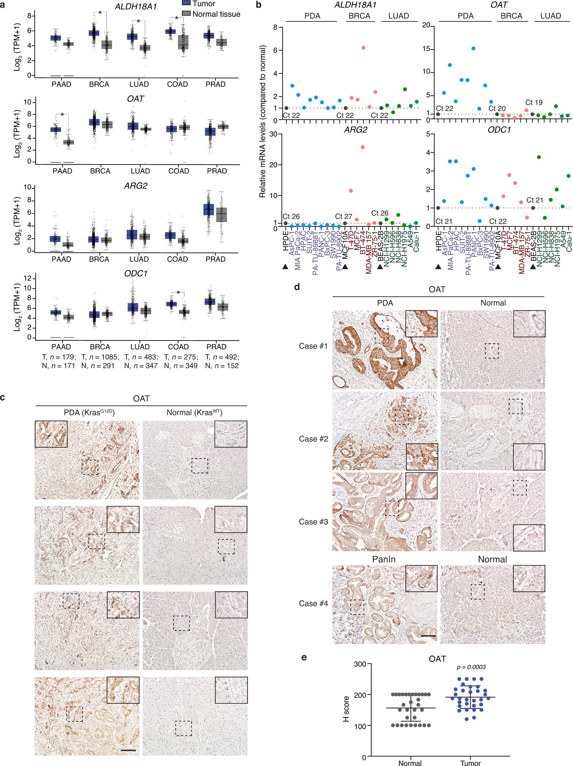 Extended Data Fig. 4: OAT is enriched in human and mouse PDA tumors.