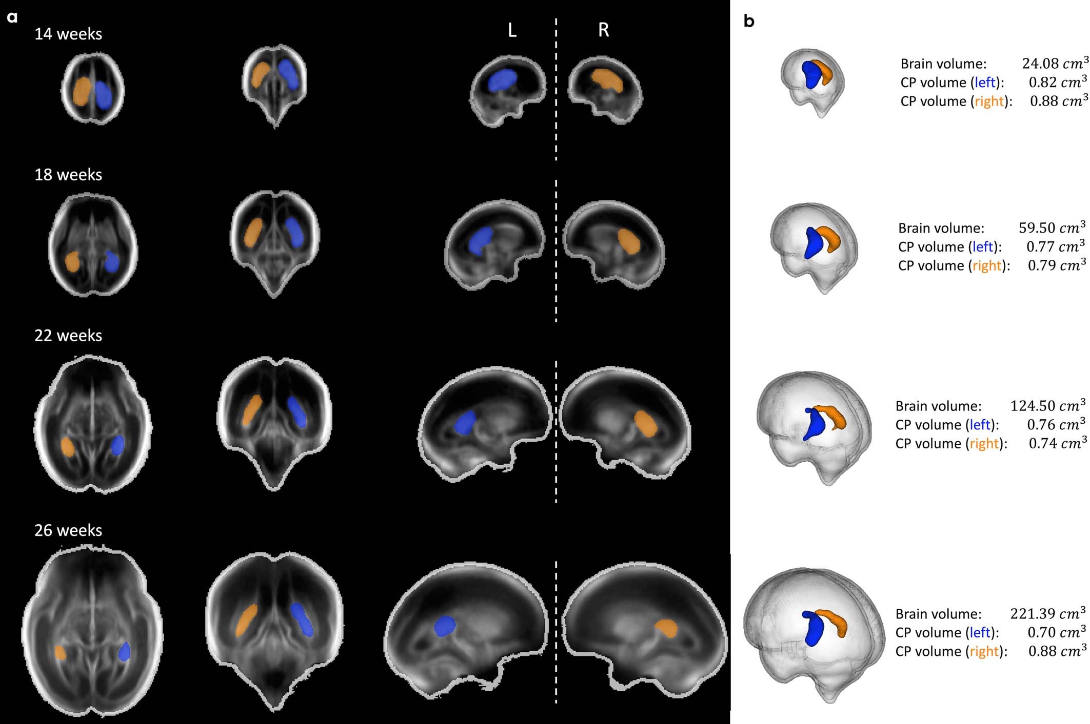 Extended Data Fig. 6: Choroid plexus asymmetry.