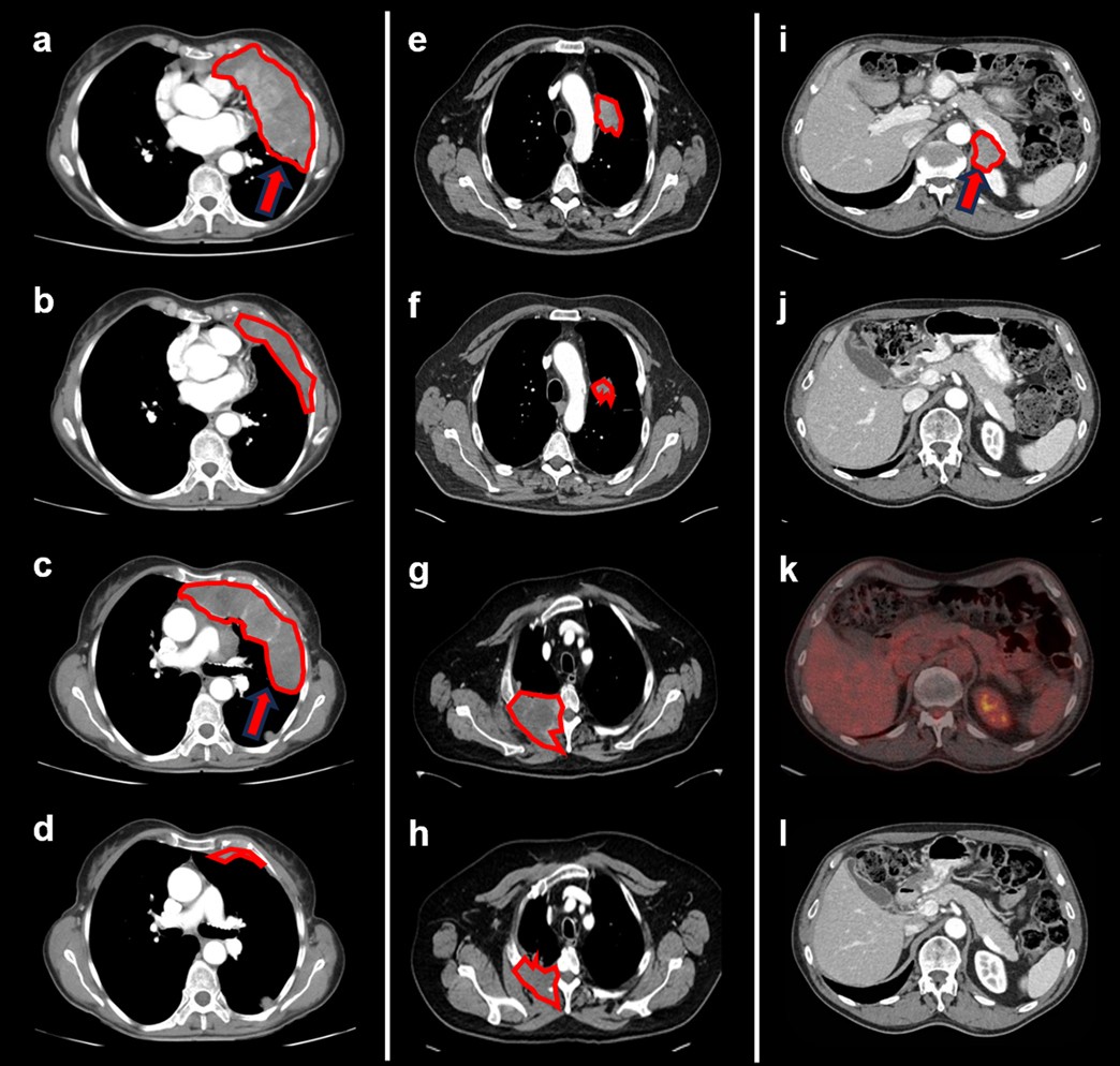 Extended Data Fig. 7: CT and PET-CT scans of responding tumours.