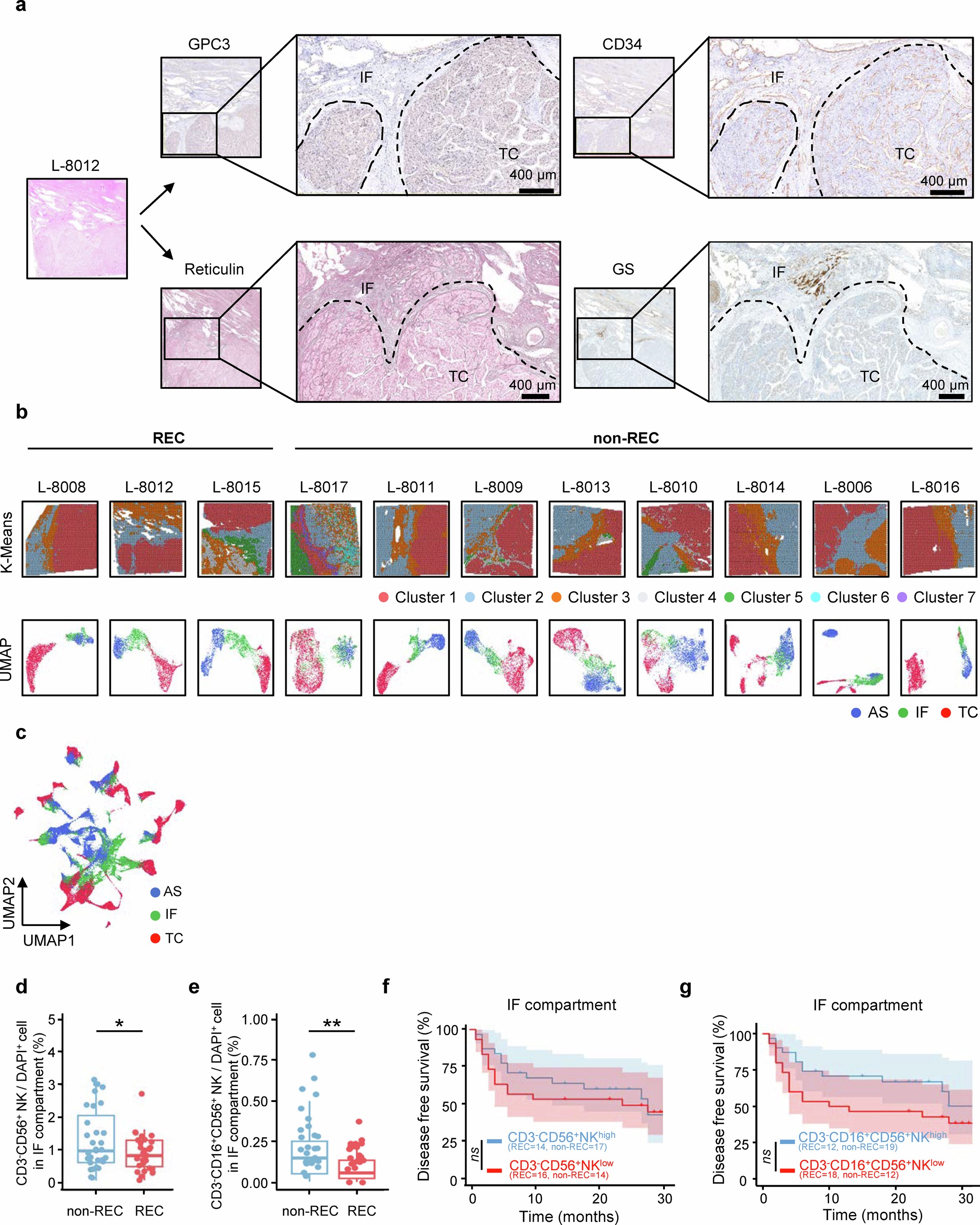 Extended Data Fig. 1: Integrative Analysis of Spatial Transcriptomics in HCC Tissue Compartments and NK Cell Protein Expression Related to HCC Recurrence.