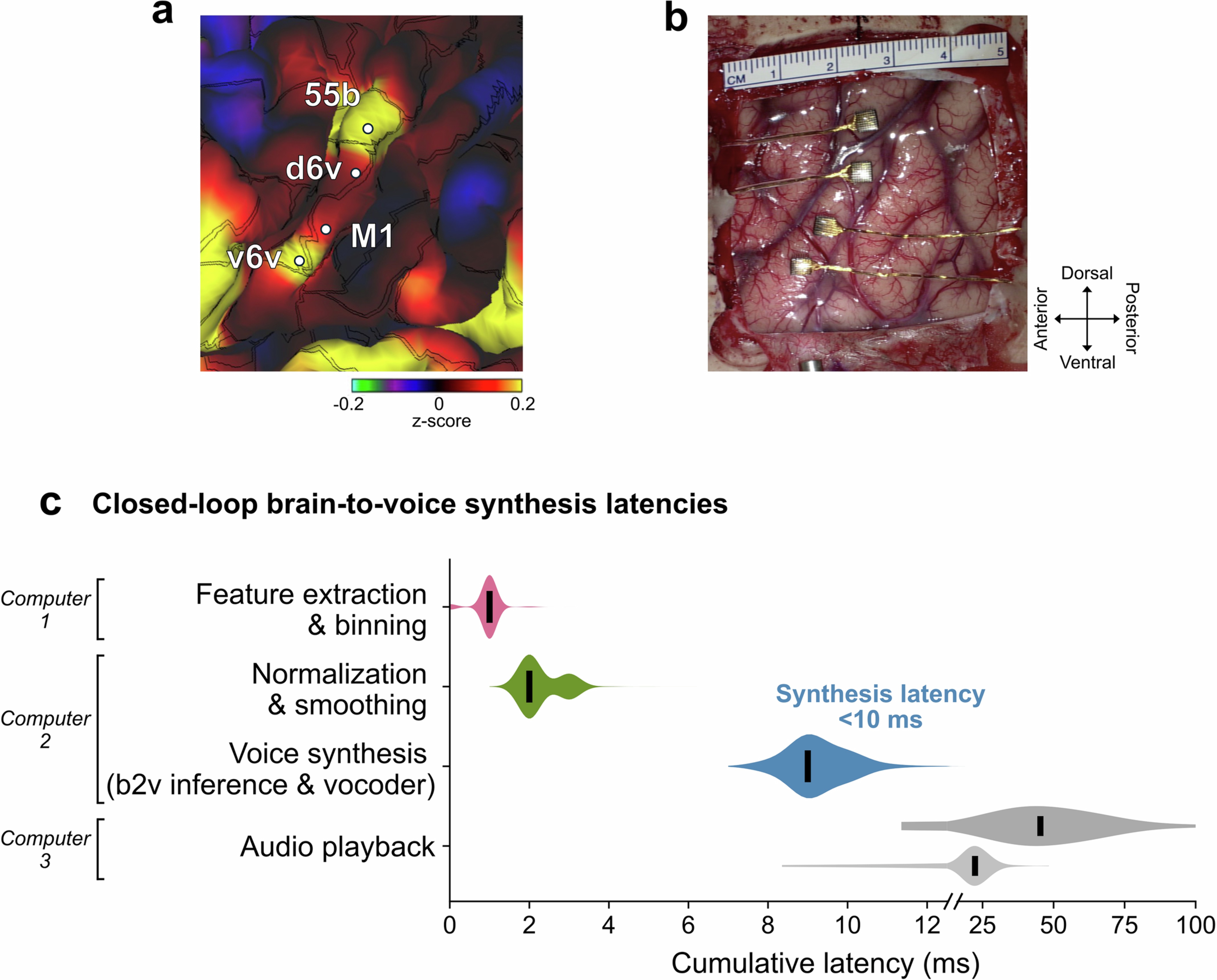 Extended Data Fig. 1: Microelectrode array placement and brain-to-voice synthesis latencies.