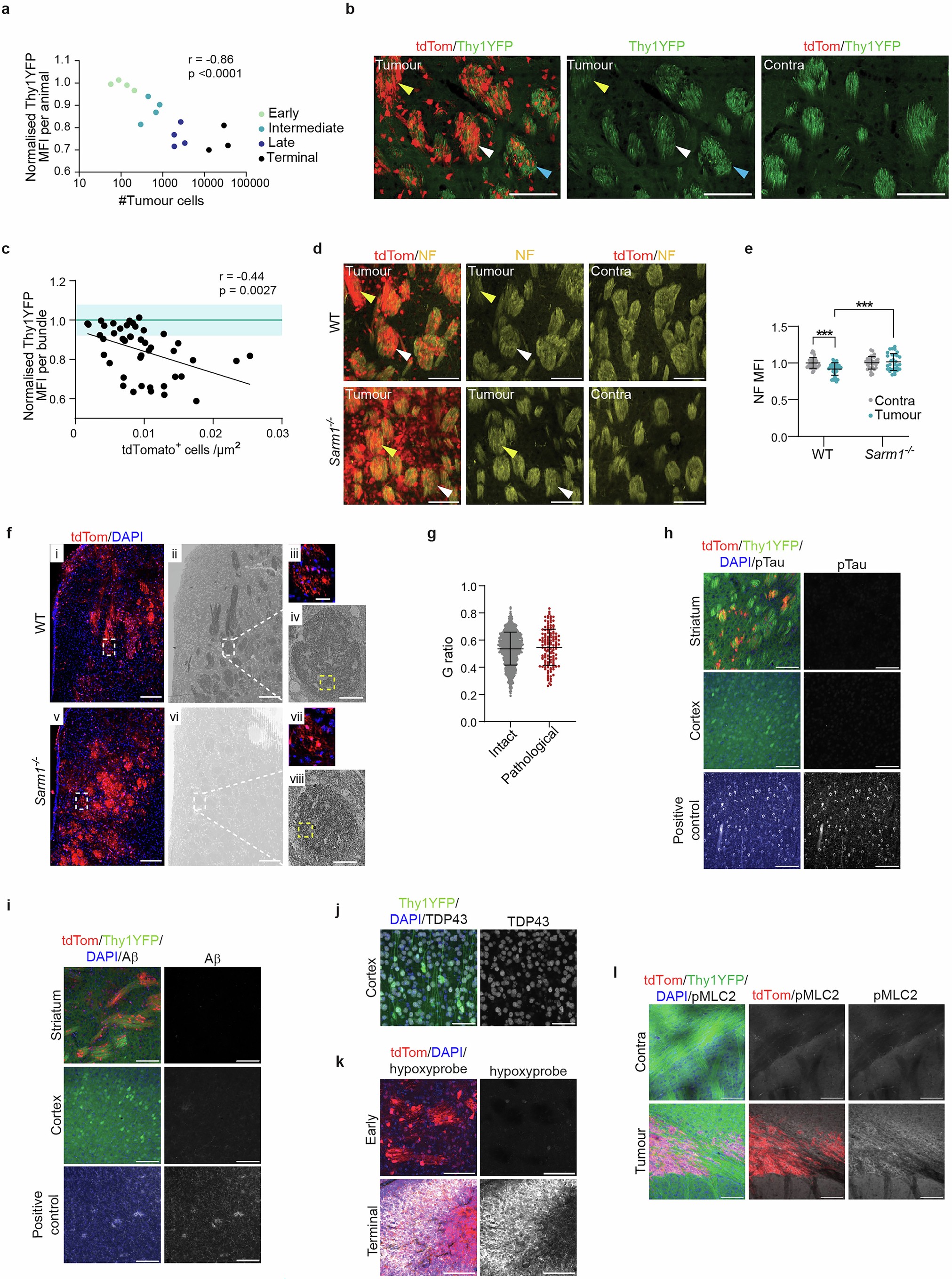 Extended Data Fig. 3: Axonal injury increases with tumour cell density.