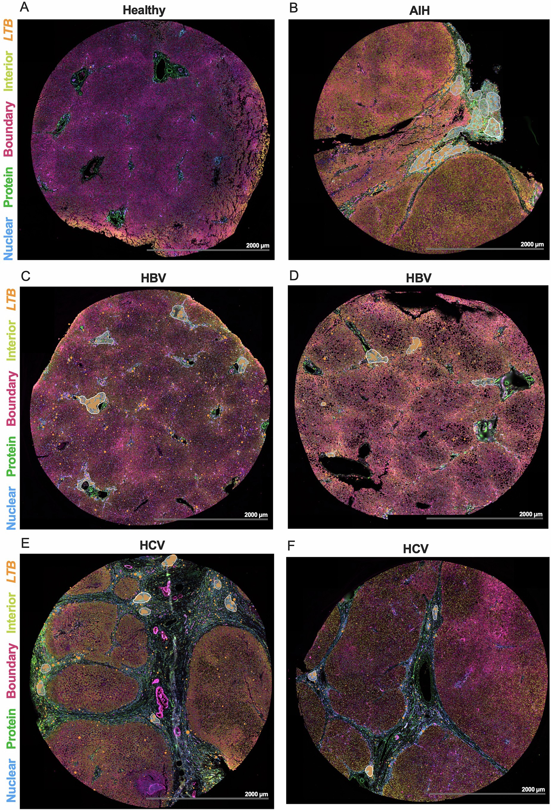 Extended Data Fig. 11: Selection of intrahepatic lymphoid aggregates in human liver tissue.