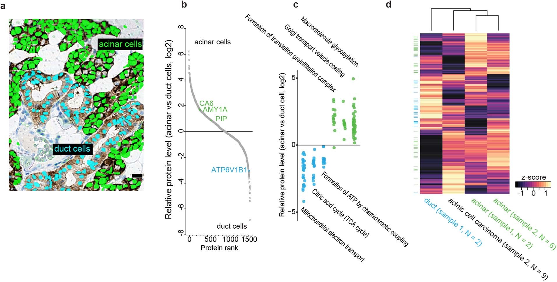 Extended Data Fig. 4: DVP applied to archival tissue of a rare salivary gland carcinoma.