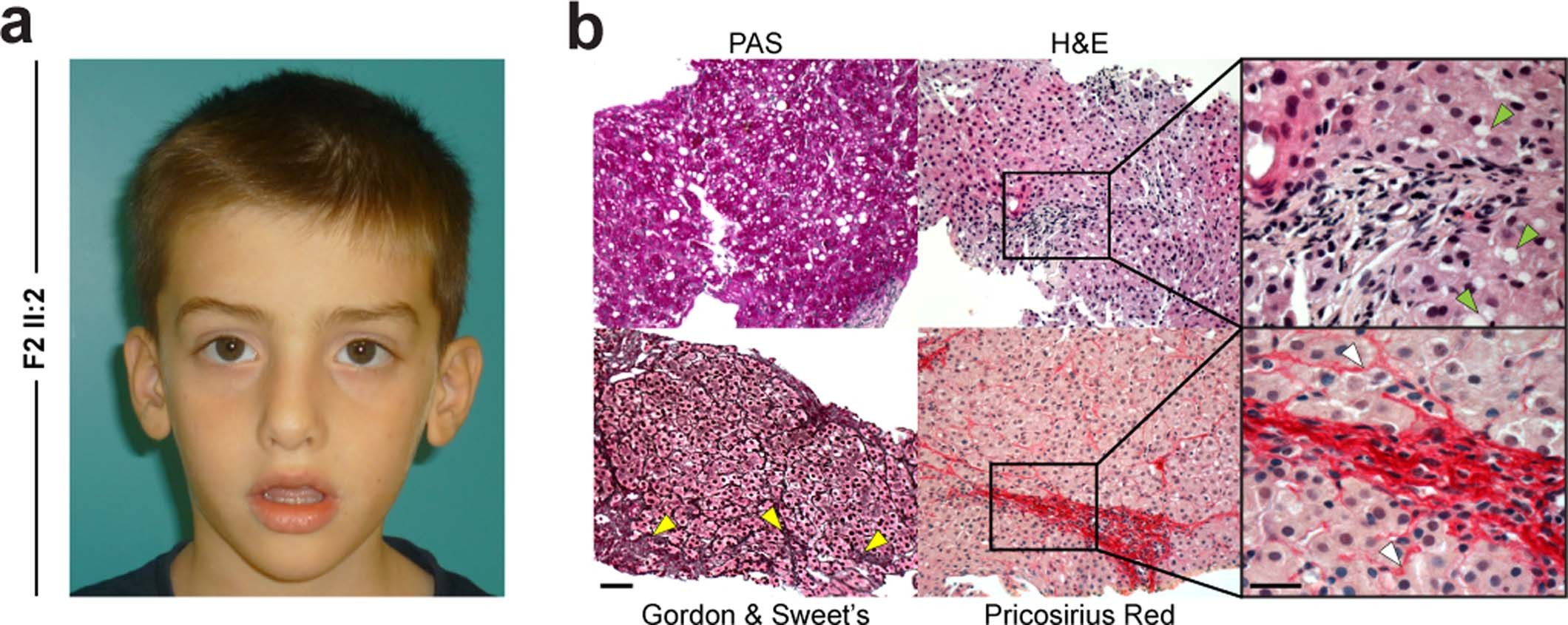 Extended Data Fig. 1: Clinical data from patient F2-II:2 (France).