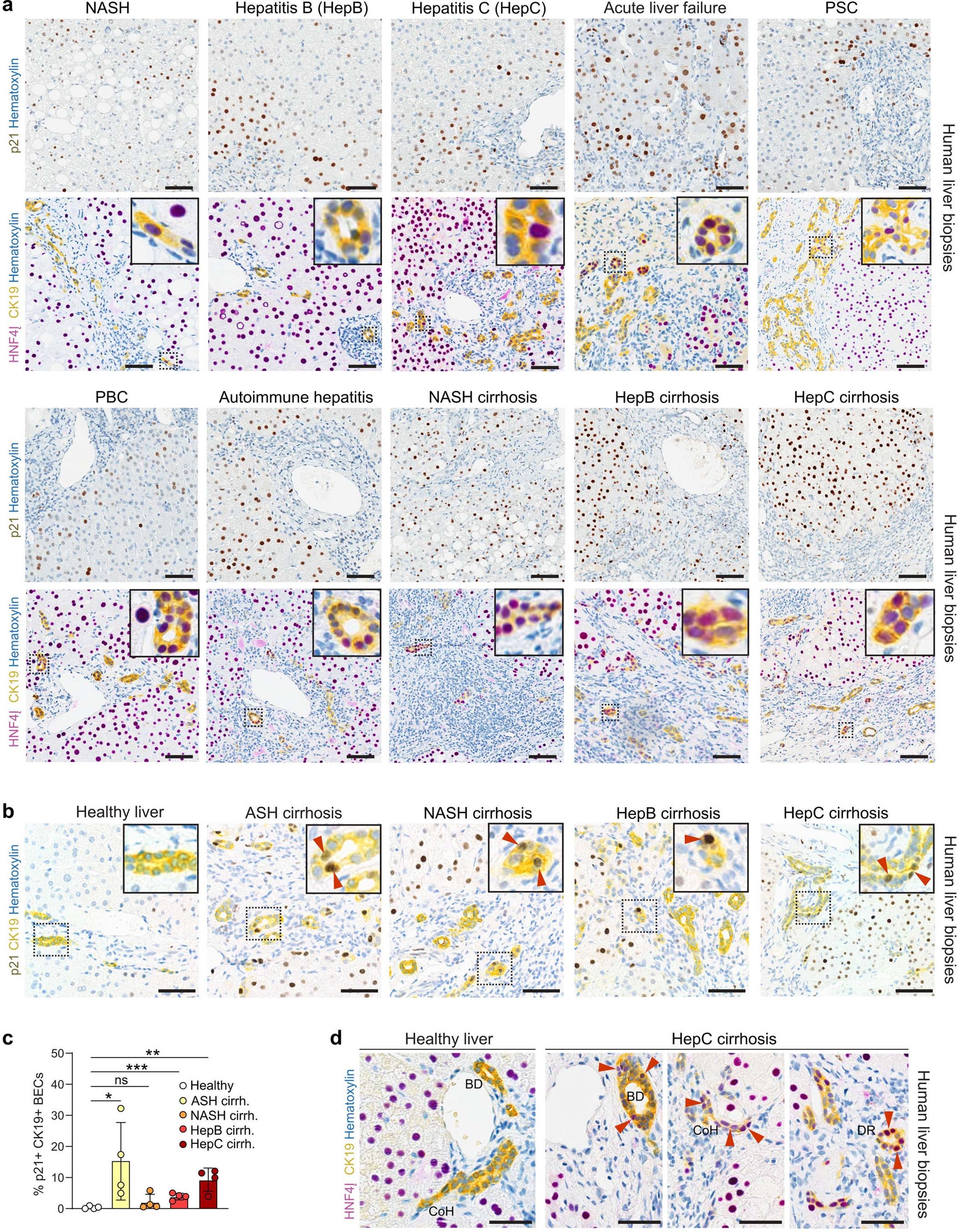 Extended Data Fig. 6: Presence of TLPCs and hepatocyte senescence in human livers.