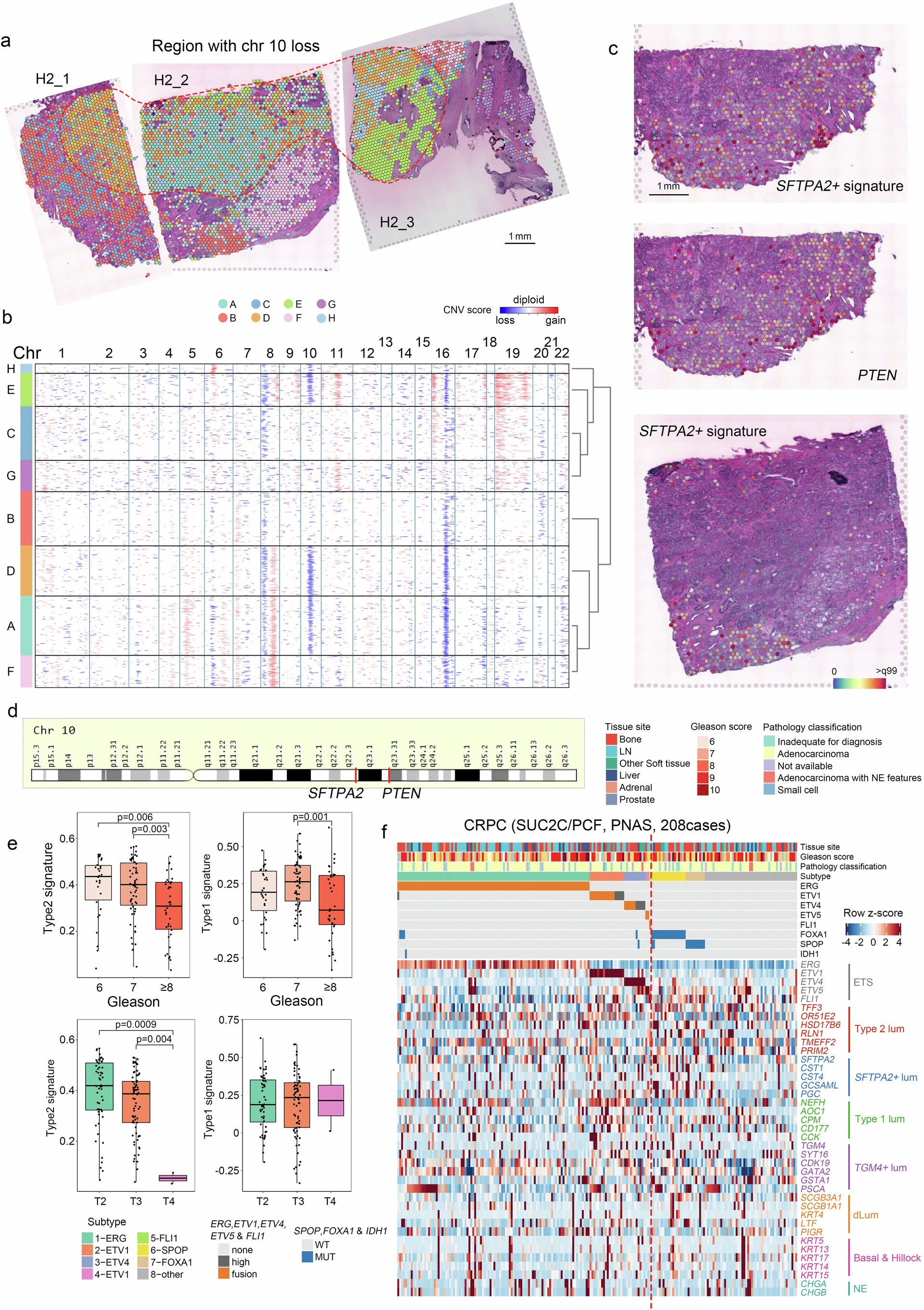 Extended Data Fig. 8: Identification of factors accounting for loss of type 2 and SFTPA2+ features in prostate cancer.