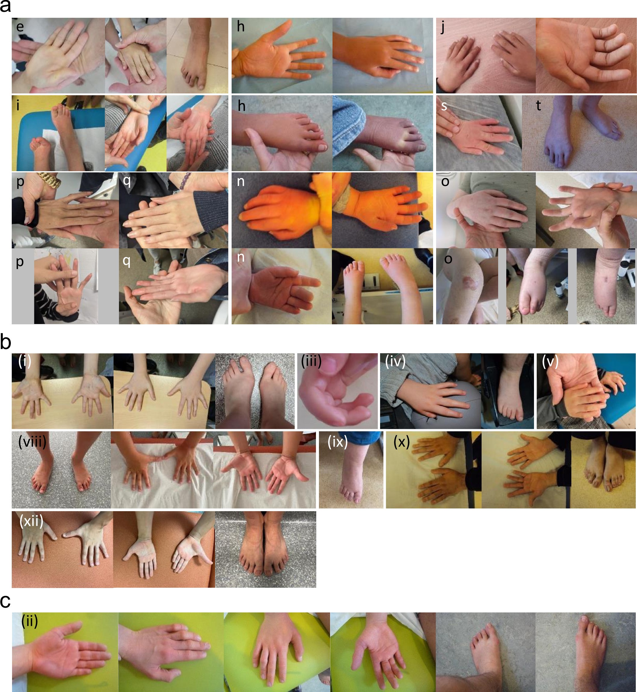 Extended Data Fig. 5: Photographs of hands and feet of patients with RNU4-2 or RNU5B-1 LP/P variants.