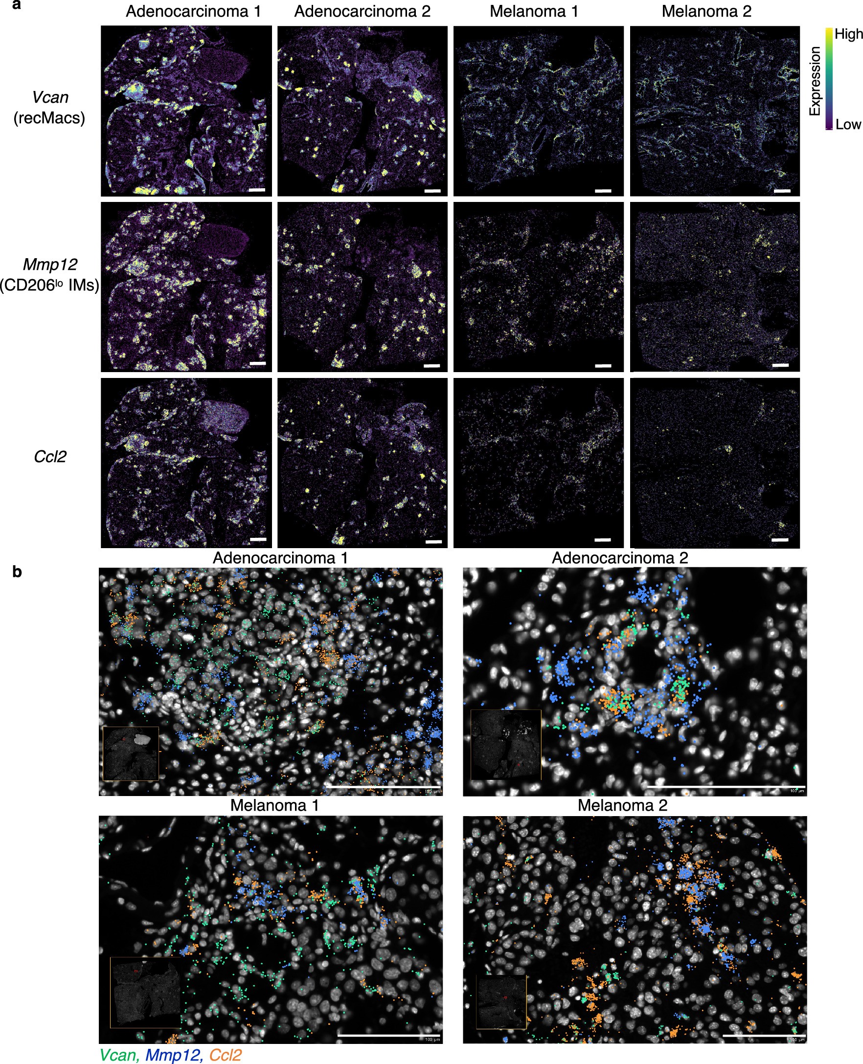 Extended Data Fig. 7: Spatial transcriptomic visualization of Ccl2 expression in IMs and recMacs in lung TME of adenocarcinoma and melanoma.