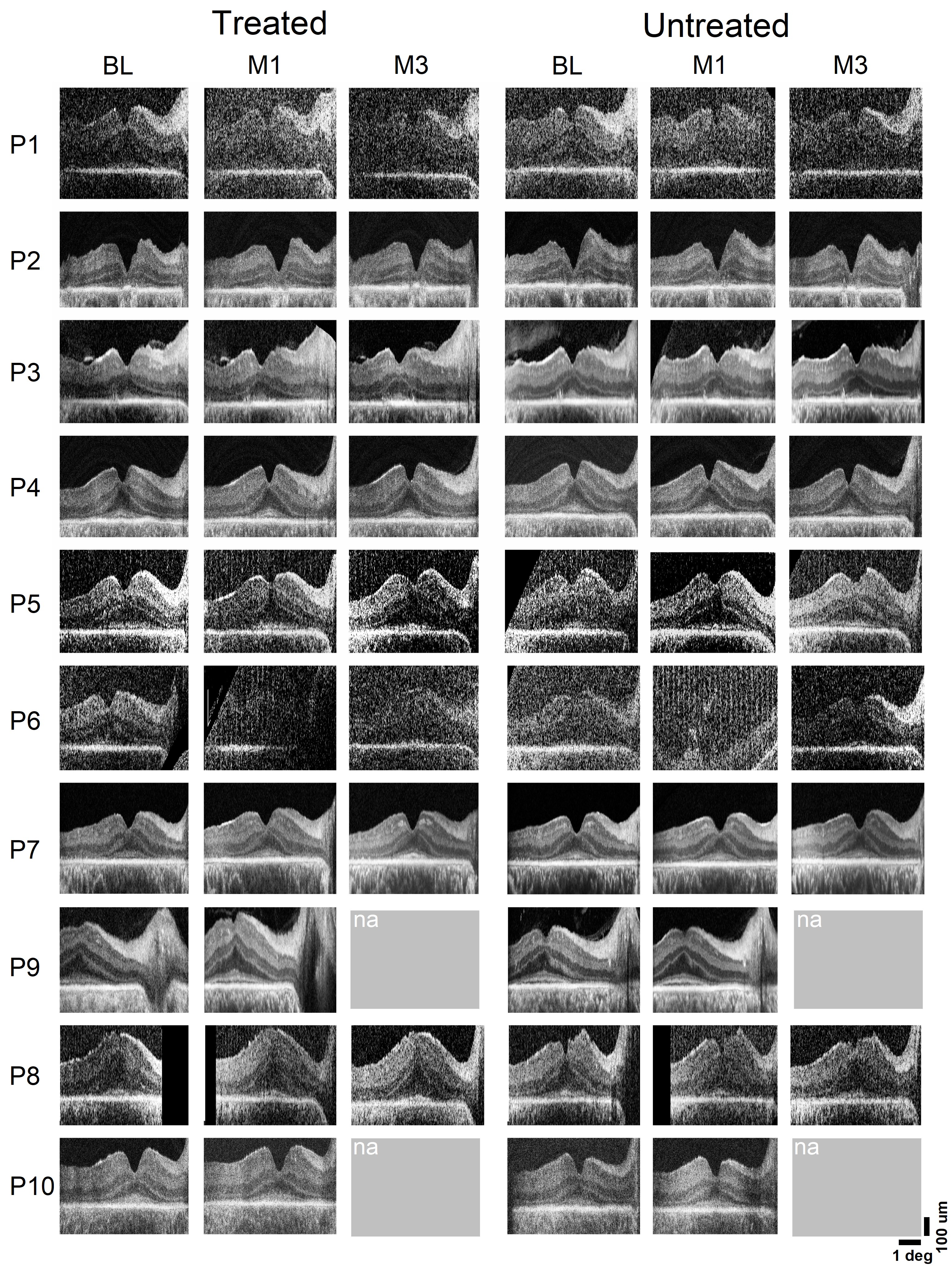 Extended Data Fig. 1: OCT scans along the horizontal meridian crossing the fovea at baseline and months 1 and 3 following the first injection.