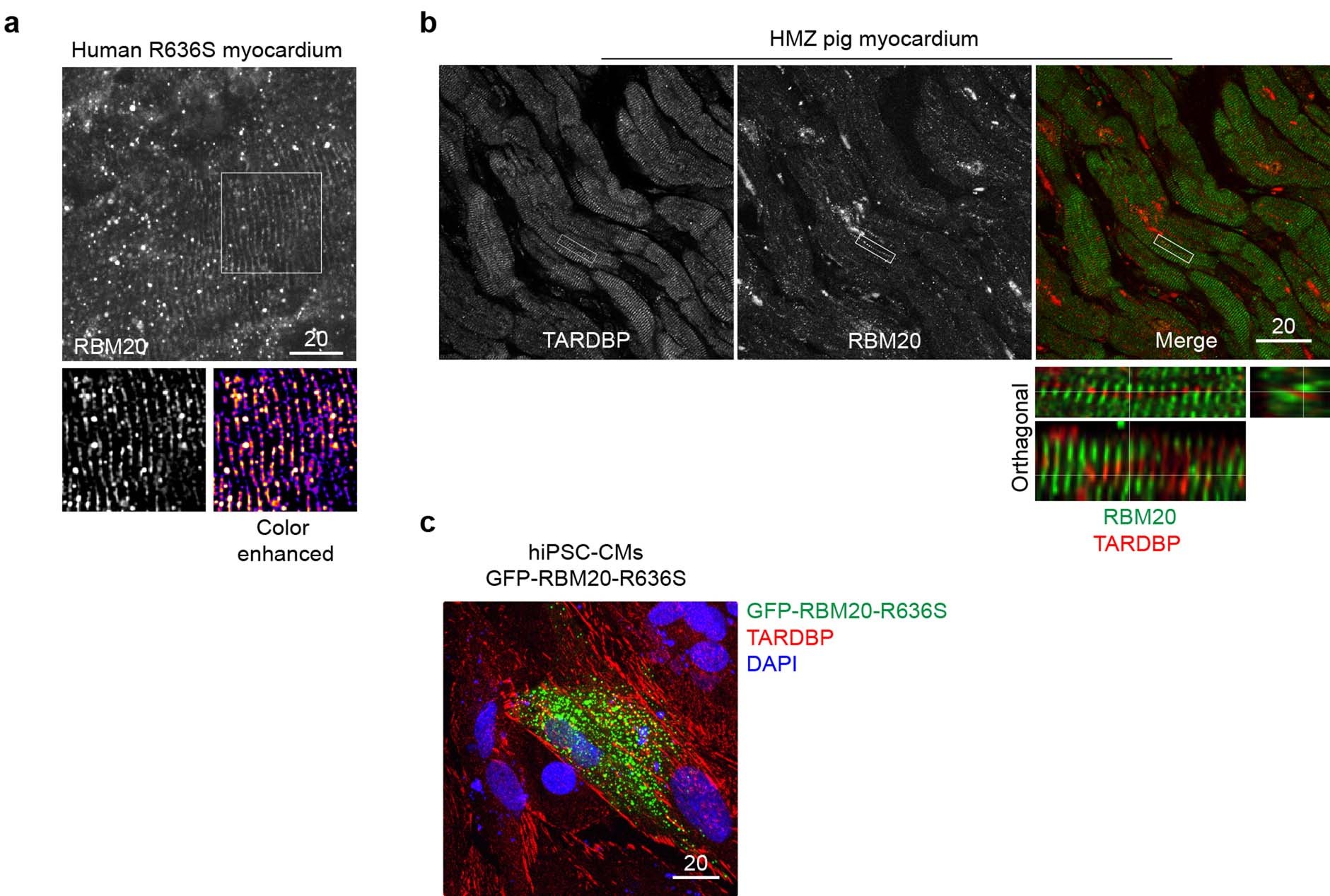 Extended Data Fig. 6: Sarcoplasmic RBM20-R636S rosary beads compared with TDP-43 myo-granules in RBM20-DCM myocardium.