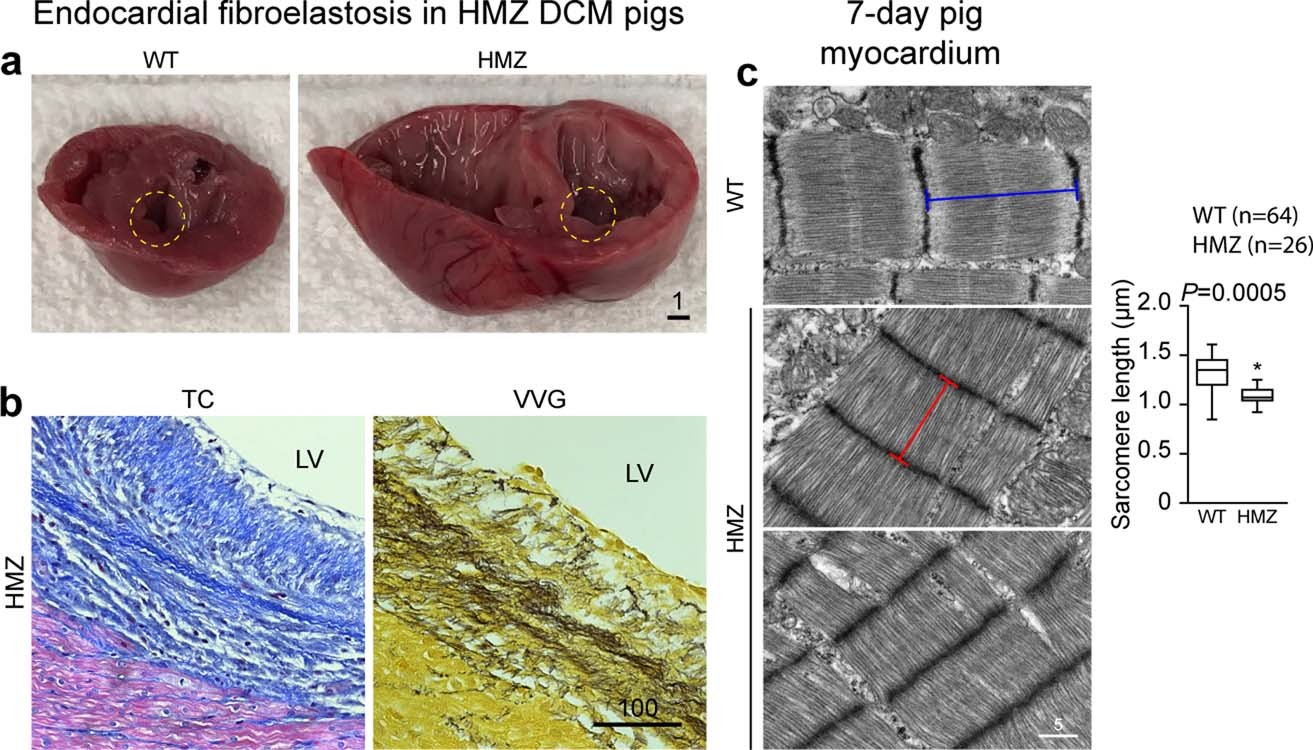 Extended Data Fig. 2: Demonstration of endocardial fibroelastosis and abnormal sarcomere organization in HMZ gene-edited pigs.