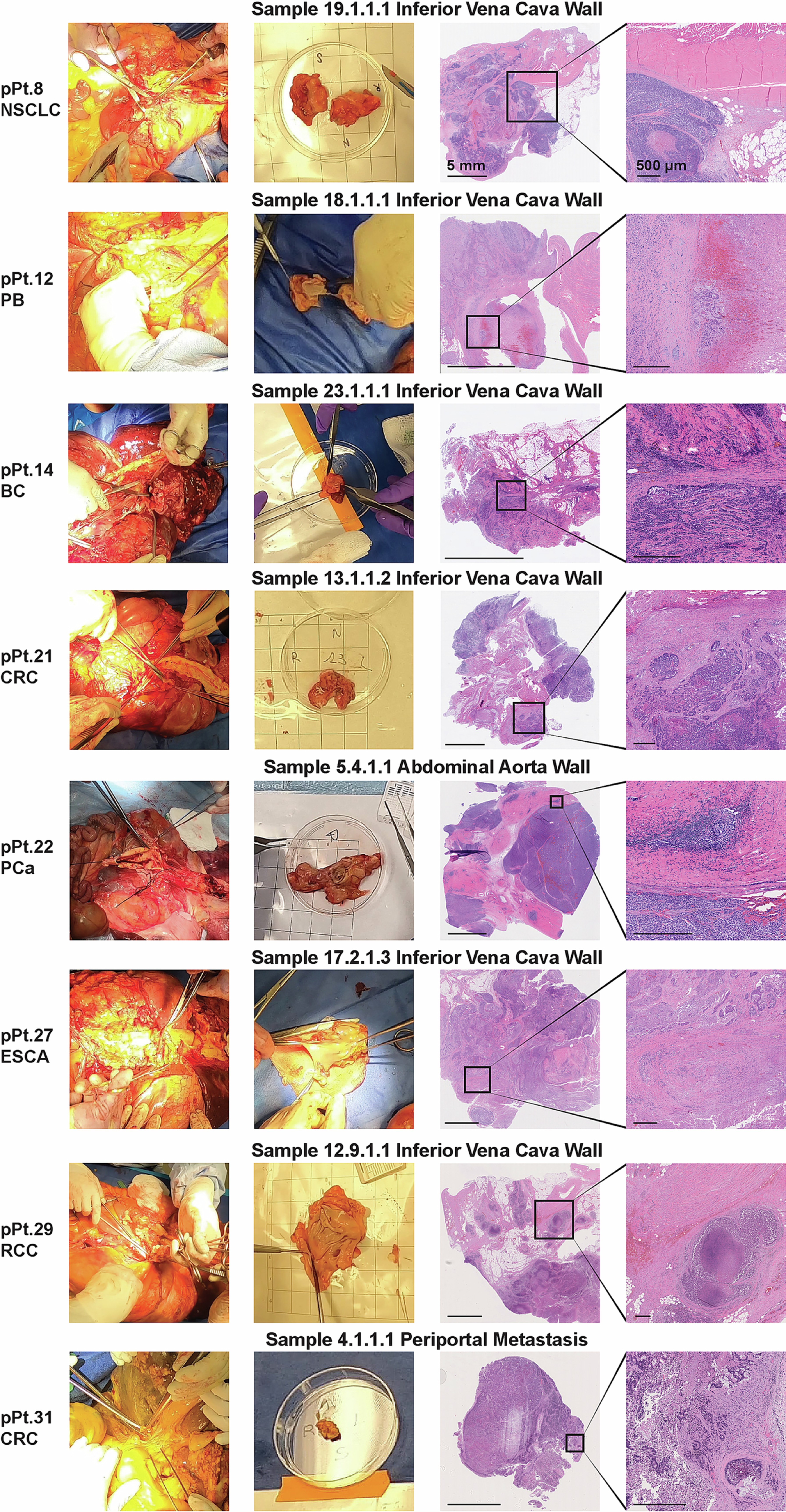 Extended Data Fig. 7: Representative gross and microscopic images of macrovascular infiltration in the UTSW prospective cohort patients.